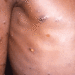 Monkey Pox | Bignewslive