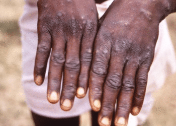 Monkeypox | Bignewslive
