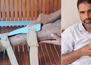 വെരിക്കോസിന് ചികിത്സ തേടി ആശുപത്രിയിലെത്തി,  ശസ്ത്രക്രിയക്കിടയില്‍ ഞരമ്പ് മാറി മുറിച്ചു, ചലനശേഷി നഷ്ടപ്പെട്ട് യുവാവ്! ഡോക്ടര്‍ക്കെതിരെ പരാതി