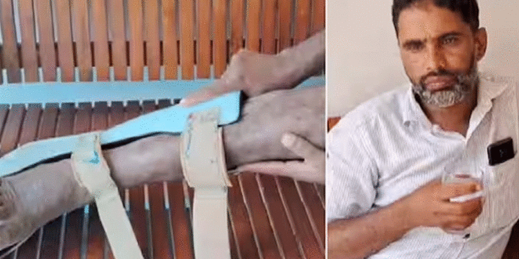 വെരിക്കോസിന് ചികിത്സ തേടി ആശുപത്രിയിലെത്തി, ശസ്ത്രക്രിയക്കിടയില് ഞരമ്പ് മാറി മുറിച്ചു, ചലനശേഷി നഷ്ടപ്പെട്ട് യുവാവ്! ഡോക്ടര്ക്കെതിരെ പരാതി