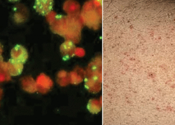 തിരുവനന്തപുരത്ത് മ്യൂറിൻ ടൈഫസ് സ്ഥിരീകരിച്ചു