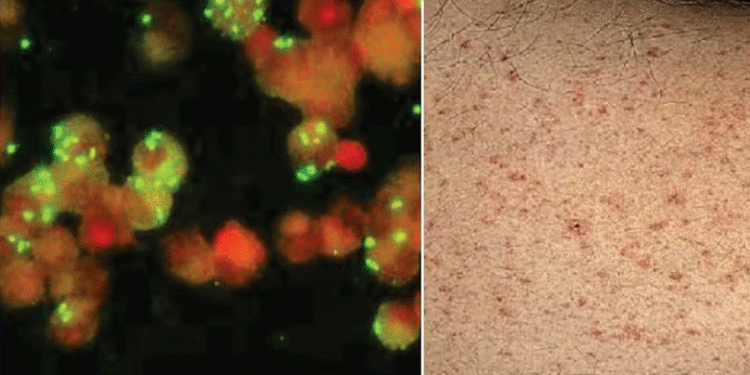 തിരുവനന്തപുരത്ത് മ്യൂറിൻ ടൈഫസ് സ്ഥിരീകരിച്ചു