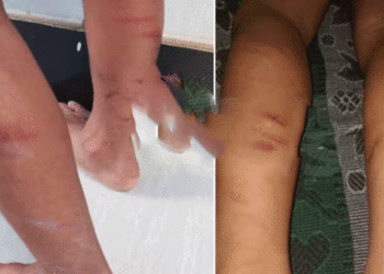 ഡയറി എഴുതിയില്ലെന്ന് ആരോപിച്ച് തൃശൂരില്‍ 5 വയസ്സുകാരനെ പൊതിരെ തല്ലി അധ്യാപിക, കേസെടുത്തു