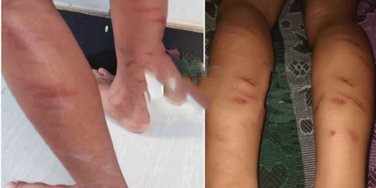 ഡയറി എഴുതിയില്ലെന്ന് ആരോപിച്ച് തൃശൂരില് 5 വയസ്സുകാരനെ പൊതിരെ തല്ലി അധ്യാപിക, കേസെടുത്തു