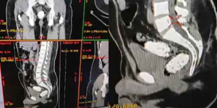 എംഡിഎംഎ ഗർഭനിരോധന ഉറകളിൽ നിറച്ച് മലദ്വാരത്തിൽ ഒളിപ്പിച്ച് കടത്താൻ ശ്രമം, യുവാവ് അറസ്റ്റിൽ