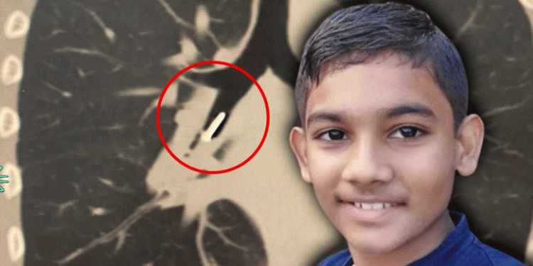 സ്കൂൾ നോട്ടീസ് ബോർഡിലെ പിൻ അബദ്ധത്തിൽ വിഴുങ്ങി; ഏഴാം ക്ലാസുകാരൻ മരിച്ചു