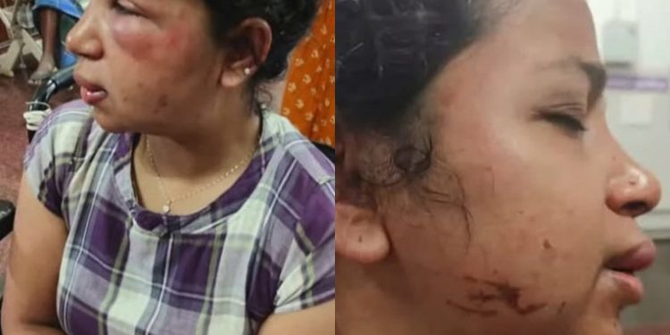 ഭർത്താവിൻ്റെ ക്രൂര മർദ്ദനം, മുഖത്ത് ഗുരുതരമായി പരിക്കേറ്റ യുവതി ചികിത്സയിൽ