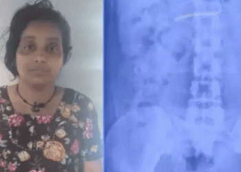 യുവതി സ്വര്‍ണമാല മോഷ്ടിച്ചു വിഴുങ്ങി, അത്യാധുനിക സംവിധാനം ഉപയോഗിച്ച് ആഭരണം വീണ്ടെടുക്കാൻ ശ്രമം